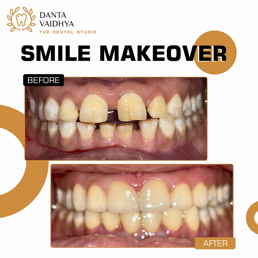 03 - DANTAVAIDHYA - PATIENT B A - SMILE MAKEOVER