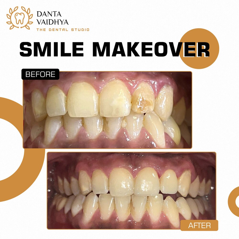 04 - DANTAVAIDHYA - PATIENT B A - SMILE MAKEOVER