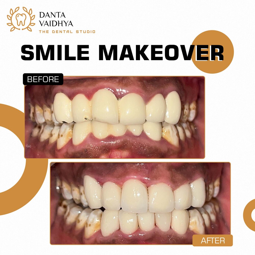 05 - DANTAVAIDHYA - PATIENT B A - SMILE MAKEOVER