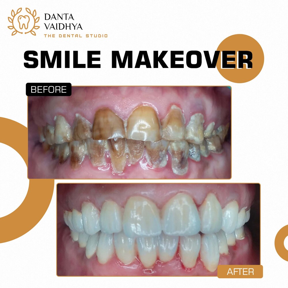 08 - DANTAVAIDHYA - PATIENT B A - SMILE MAKEOVER