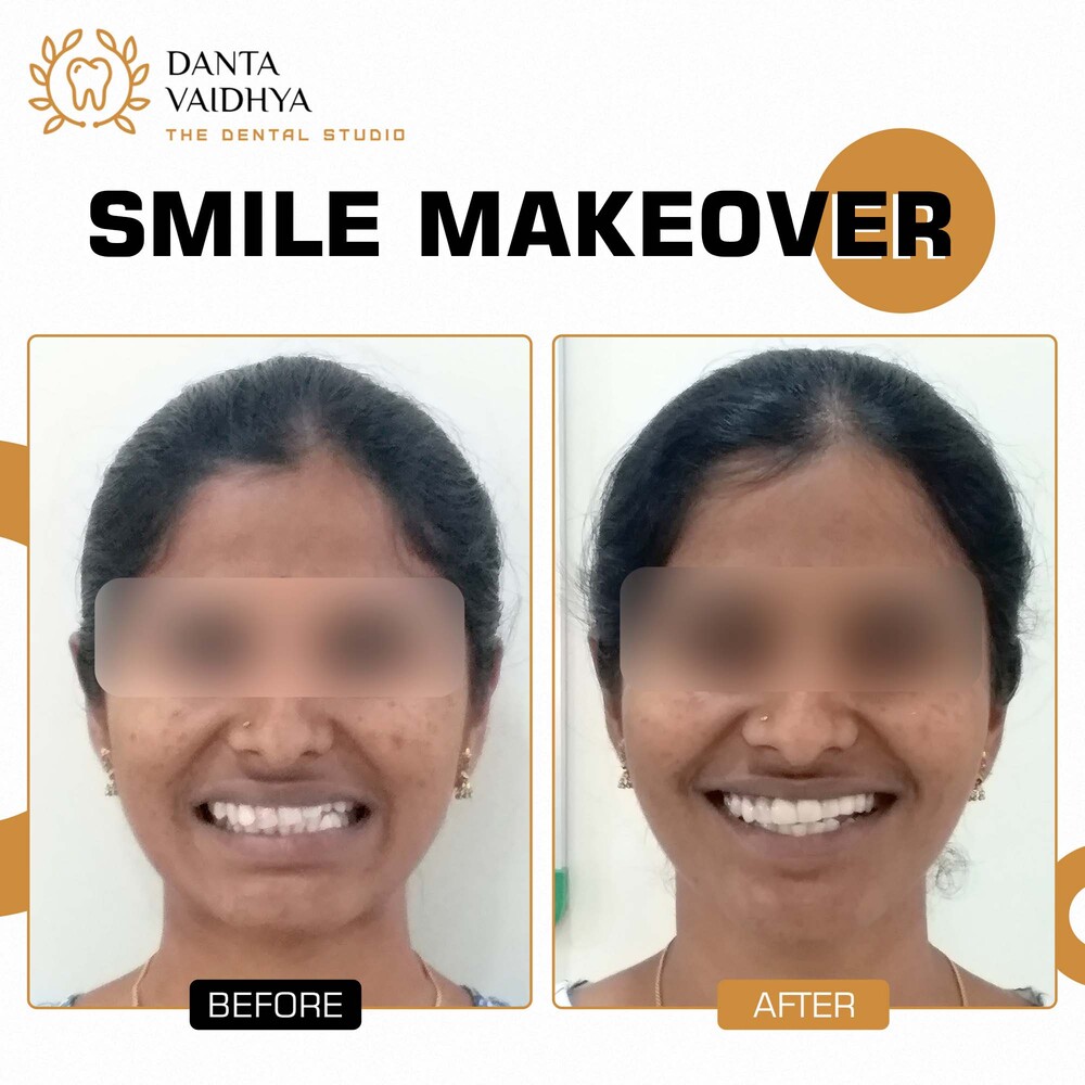 09 - DANTAVAIDHYA - PATIENT B A - SMILE MAKEOVER
