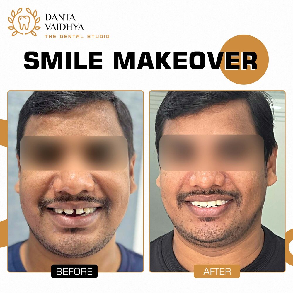 10 - DANTAVAIDHYA - PATIENT B A - SMILE MAKEOVER